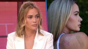 Teddi Mellencamp Gives Health Update as She Begins Immunotherapy Amid Melanoma Diagnosis